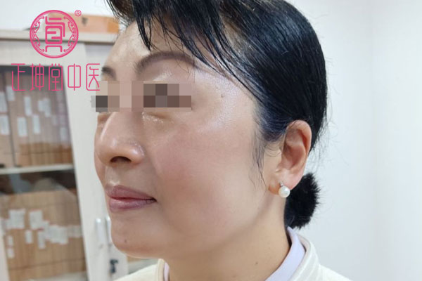 更年期皮肤干燥如何调理