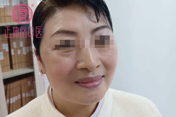 更年期皮肤干燥如何调理