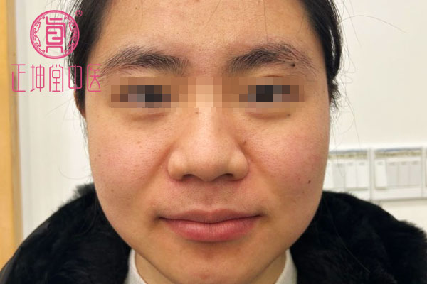 刘女士患有卵巢囊肿