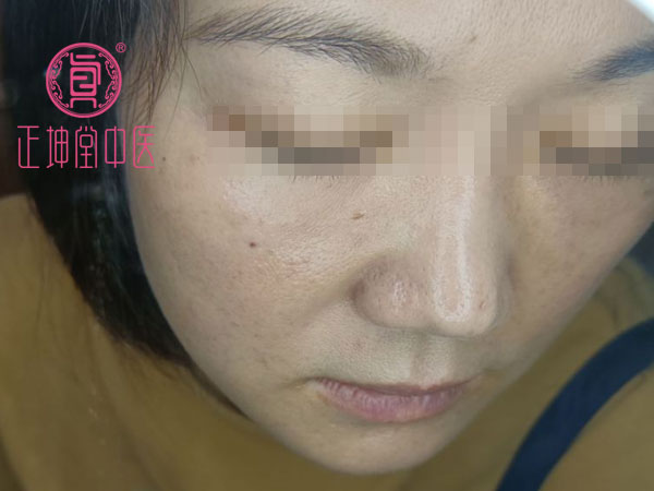 产后皮肤粗糙干燥怎么办